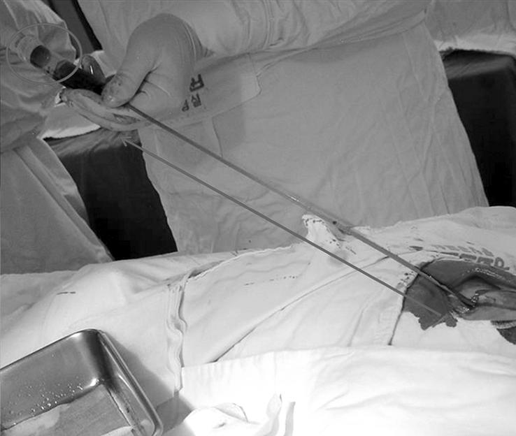 Su Youn Lee, et al:aspiration Thrombectomy for Deep Vein Thrombosis 141 Fig. 1. Pullback technique. We perform percutaneous aspiration thrombectomy using Pullback technique.