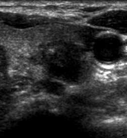 in the lower portion of the left lobe (A).
