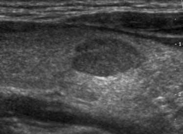 3 cm, is also found in the right lobe (E).