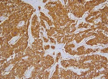 Representative immunohistochemical findings of medullary carcinomas show positive reaction of calcitonin (A), synaptophysin (B), and CEA (C) in case 1, case 2 and case 3, respectively.
