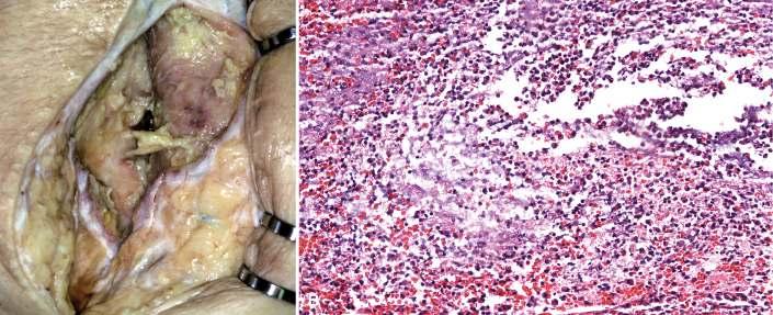 SUPPURATIVE OR PURULENT INFLAMMATION Production of large amounts of pus or purulent exudate-pyogenic bacteria Abscess: localized collection of purulent inflammatory tissues-central