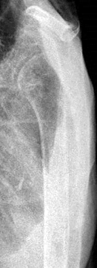 (A) A 78-year-old female with a displaced proximal