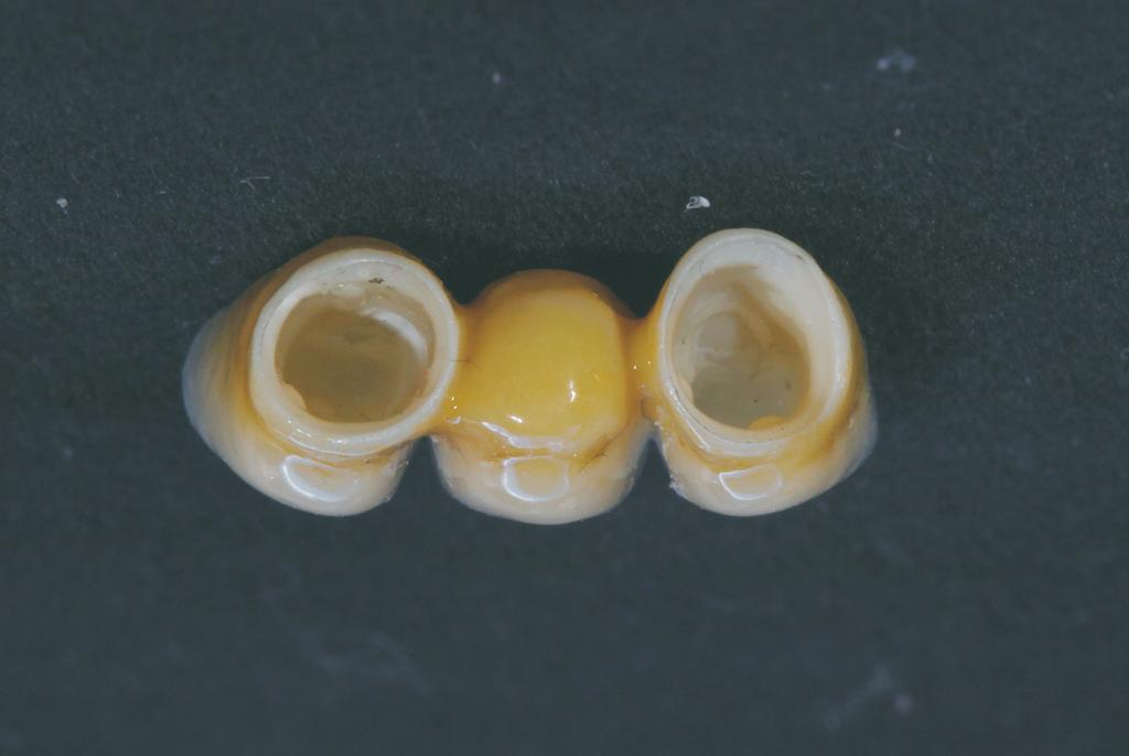 Fig. 4. Internal surface of Non Cement Fixation implant prosthesis.