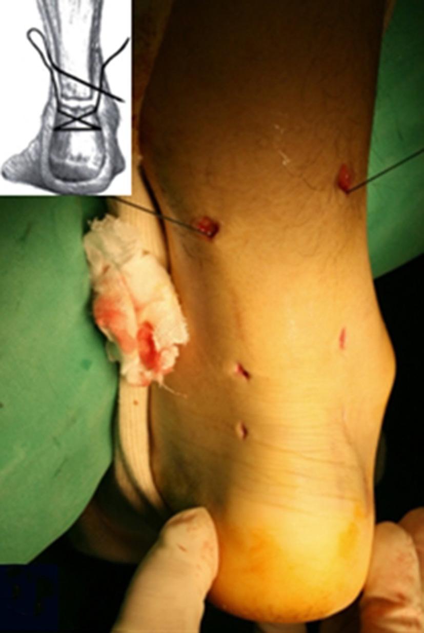 First, a long needle was transversely passed through the tendon (A), followed by a (diagonal) cross-suture (B).