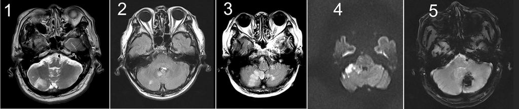 Figure 1. Brain MRIs from the patients with acute dizziness show cerebellar infarctions on T2-weighted, FLAIR, diffusion-weighted images and a left cerebellar hematoma on gradient echo image.