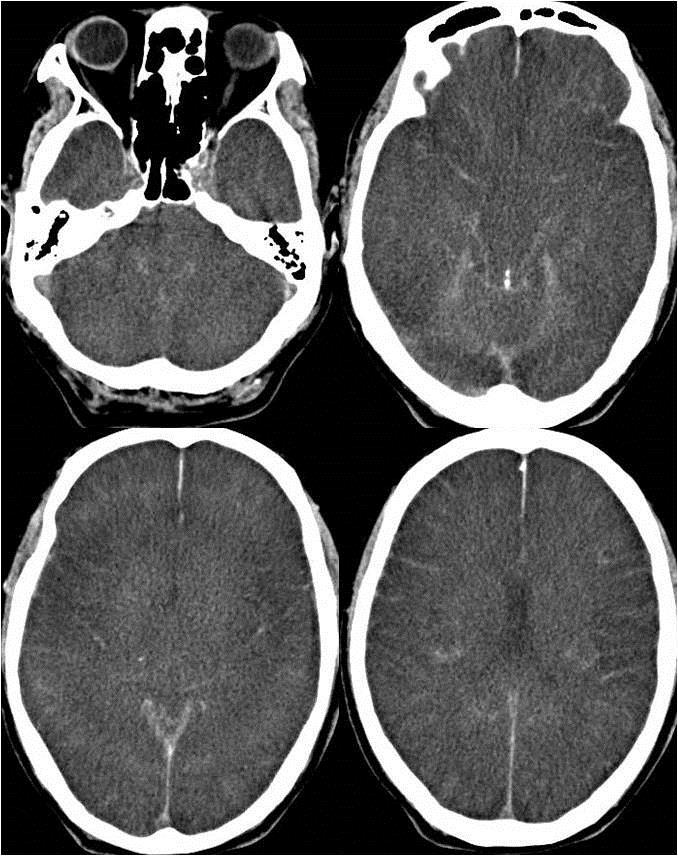 Hyeran Kang, Yoon Mi Shin, Sung-Hyun Lee Fig.1. Brain CT showing diffuse ischemic encephalopathy 7 days after the ischemic insult.