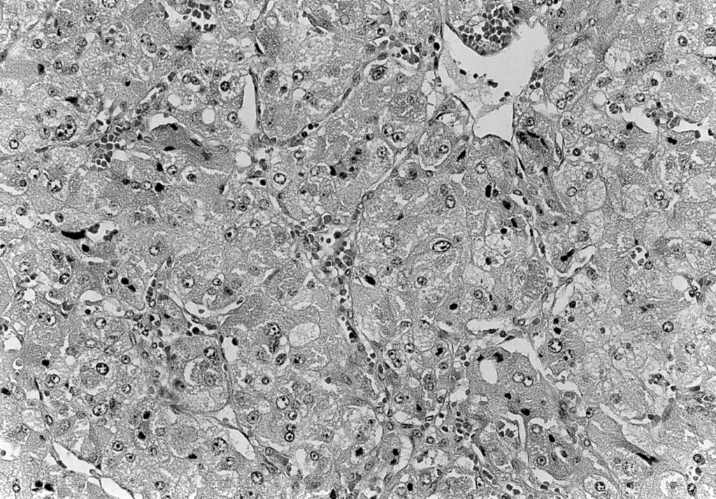 A B Fig. 5. (A) Rounded nests of chief cells circumscribed by fibrovascular network. The vascular proliferation is particularly prominent in this example.