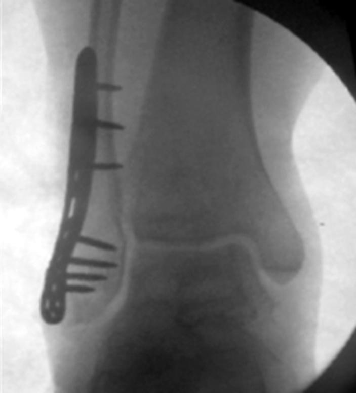 (A) The resection of the lateral malleolus was done during the approach to the lateral talar
