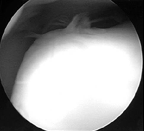 These pictures show second look arthroscopy after autologous chondrocyte implantation of
