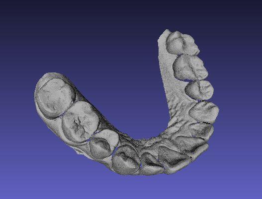 [Figure. 1] Stereolithographic data obtained from scanning with intra-oral scanner 'CS 3500' [Figure.