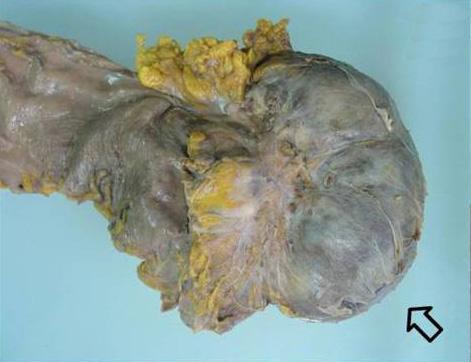 위내시경소견 : 위분문부에서 5 5 cm 크기의돌출하는 Figure 2. Endoscopic finding of the tumor.