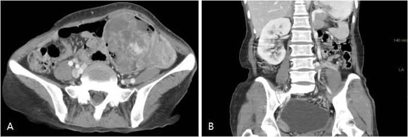 - Ju Young Lee, et al. Ectopic ovarian mixed epithelial tumor associated with unicornuate uterus - Figure 1.