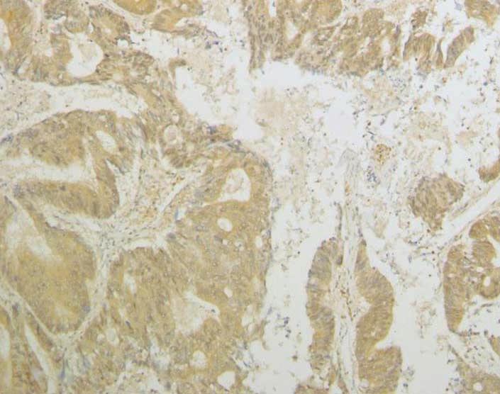 receptor (VEGFR)-2 in colorectal cancer and liver
