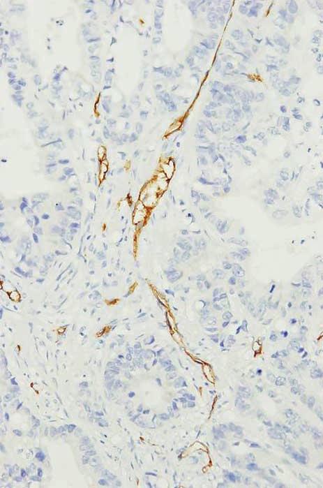 immunohistochemical staining in colorectal cancer