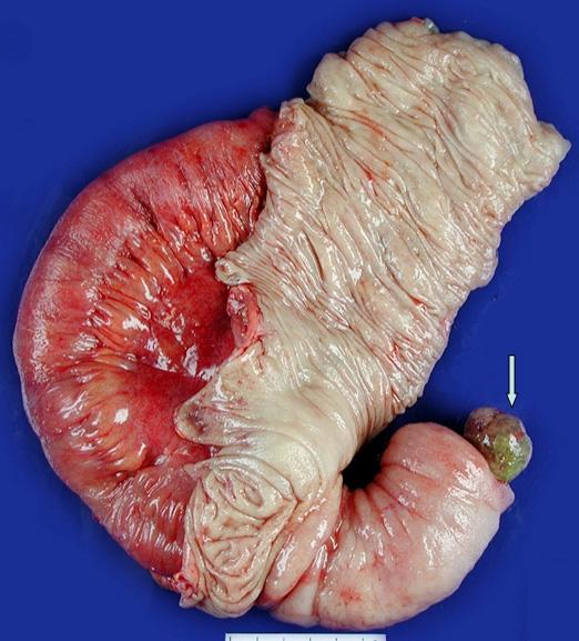 ascending colon. (B) The polyp is composed of proliferated fibroblasts with collagen deposition and numerous eosinophils, microscopically (H&E stain, 400). Figure 4. Fluoroscopic findings.
