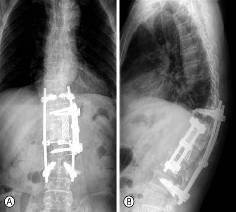 Bo Ram Kim, et al: Delayed Subsequent Refracture of a Thoracolumbar Vertebral Compression Fracture Fig. 2.