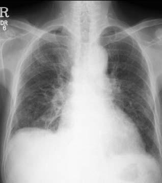 Tuberculosis and Respiratory Diseases Vol. 59. No. 6, Dec. 2005 (A) (B) Figure 1. (A) The chest PA showed pleural effusion in the right side.