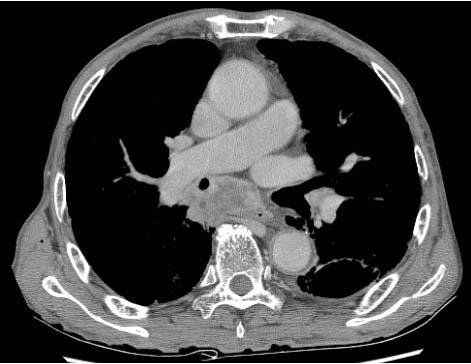 HS Chung et al. : Squamous cell lung cancer with hyperamlasemia Figure 4.