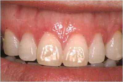 terephthalate thermoplastic, PET-G) 인듀란 (Duran R 1.0 mm, Scheu Dental, Germany) 쉬트를이용하여가압성형한후디자인에따라자르 고연마하여완성하였다.