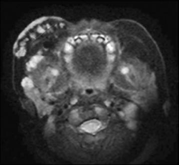 (D) Ultrasonogram taken after 1 year of propranolol treatment showing decreased depth of hemangioma from 1.0 cm to 0.5 cm. 을보였으며, 시행한뇌파및자기공명영상상특이소견을보이지않아케톤성저혈당에의한경련으로진단되어프로프라놀롤과는무관하게판단되었다.