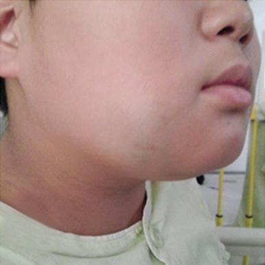 Kyung Moon Kim, et al Fig. 2. (A) Deep type hemangioma located in right cheek of 11-year-old boy who was diagnosed at 6 years of age and treated with corticosteroid for 5 years with poor response.