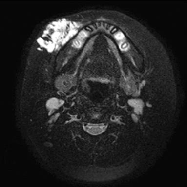 Evaluation results of 20 pediatric hemangioma patients treated with propranolol over one year Evaluation items Value Blood glucose (mg/dl) median (range) 96.