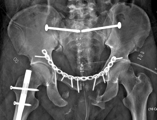sacral fracture at S1/S2. (C) A bilateral sacroiliac screw was fixed after closed reduction and anterior plating.