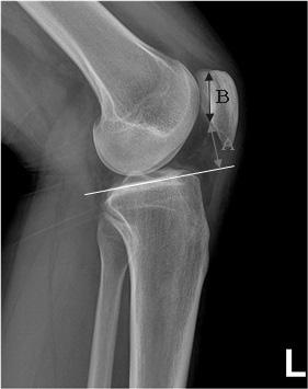 1) Medial retinacular rupture Chondromalacia in medial patella Bone bruise in lateral femoral condyle.