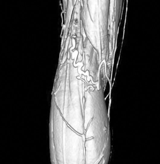Yong Chan Shin, et al:atypical Varicose Veins in the Popliteal Fossa Unrelated to Small Saphenous Vein Reflux 185 Table 1.