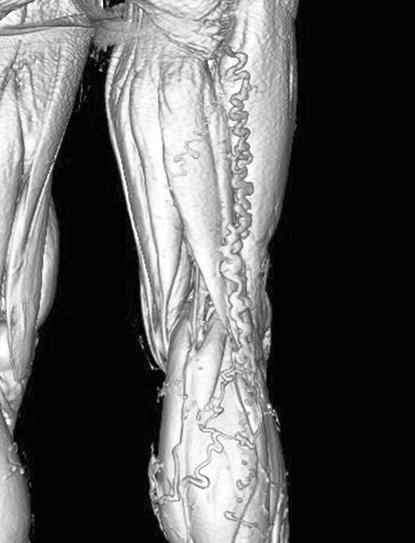 Three-dimensional computed tomography venography imaging of varicosity of popliteal fossa caused by the right upper thigh lateral perforator insufficiency. Fig. 5.