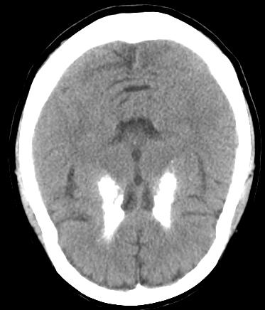 Fig. 2. Brain computed tomography showing multifocal diffuse low attenuated lesions in bilateral basal ganglia, dentate nucleus, and thalamus. 비교적적절하게유지되었다.