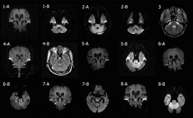 김현아외 Fig. 1. MRIs of patients with an isolated or predominant body lateropulsion disclose lesions restricted to the just ventral portion of the 4th ventricle in the pontine tegmentum. 부에위치하고있다.