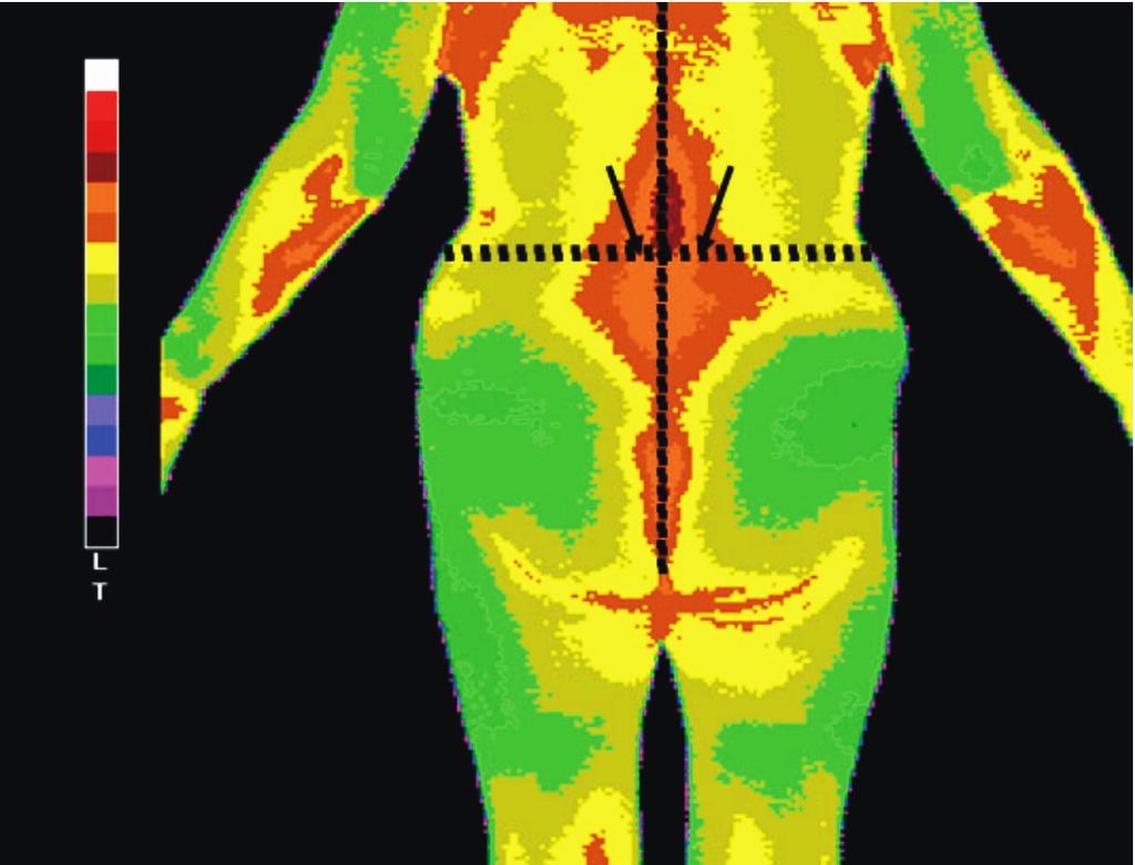 Yong-Eun Cho, et al. Infrared Thermography of the Various Spinal Diseases 온도차를 비교 한다면 어떠한 부위가 비정상적 인지도 알 할 수 있는 온도차를 구하였다. 좌우의 온도차가 0.1 이 수 있게 된다.