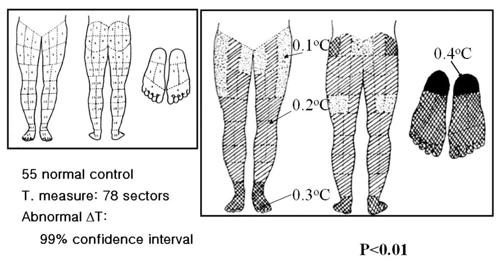 측정 부위는 좌우의 상부 장골능(superior iliac crest)을 잇는 선과, 정중 시상선 에서 좌우에 있는 척추기립근(erector spinalis muscle)의 중 앙 부위의 온도를 측정하였다. 정상인의 요추부의 좌우 온도차는 0.2008±0.1861 였 다. 95% 신뢰도에서 좌우의 온도차는 0.