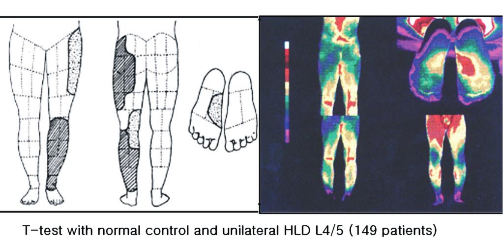 Yong-Eun Cho, et al. Infrared Thermography of the Various Spinal Diseases Fig. 5. L5 thermatome. Fig. 6. S1 thermatome. (2) 경추부 신경근의 온도절(Thermatomes of the cervical nerve roots) 과 0.
