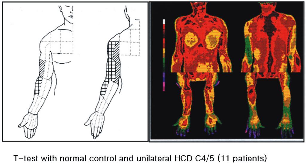 조용은외 1. 척추질환의체열촬영 Fig. 7. C4 thermatome. Fig. 8. C5 thermatome. 과 0.05의수준에서제6 경추신경근의온도절을만들었다 (Fig. 9). 제7 경추신경근의체온절은제6/7 경추간판탈출이편측으로있어서편측의제7 경추신경근만을압박하는환자 30명과정상인 50명의 data를 t-test로비교하여 p value 0.01.