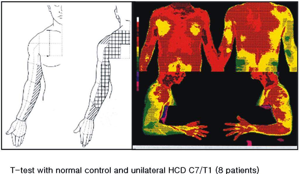 조용은외 1. 척추질환의체열촬영 Fig. 11. C8 thermatome. Correlation between Pain Scale and ΔT in HLD Fig. 12. Correlation between subjective pain and ΔT in leg.