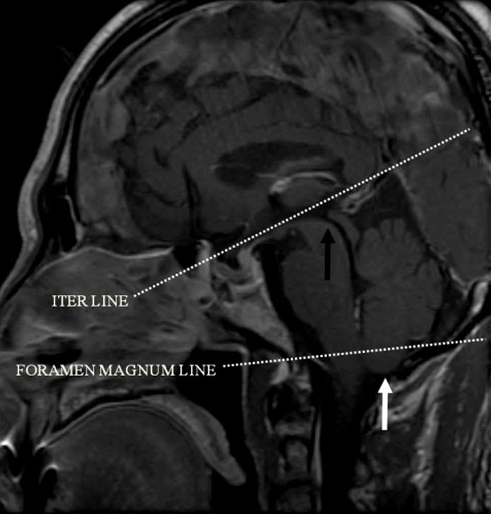 486 Sex, female (%) 25 (57) 15 (71) 10 (44) 0.058 Time to first MRI (Mean±SD, day) 7.57±6.21 5.71±3.73 9.26±7.51 0.063 Associated symptoms Nausea, vomiting, n (%) 28 (64) 17 (81) 11 (48) 0.