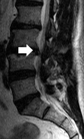 . The seventy-three year old male performed repeat MRI on 7 months