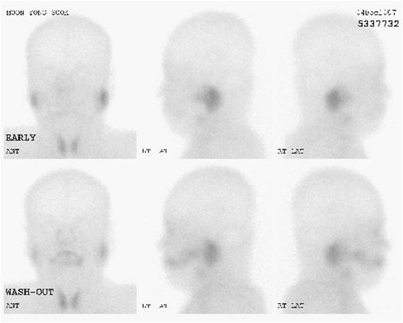 - 대한내과학회지 : 제 77 권부록 1 호 2009 - A B Figure 2. (A) Salivary gland scan showed decreased uptake of radionuclide in the bilateral parotid and submandibular glands.