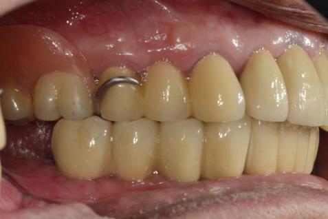 초기 내원 시 #11, 21, 22, 23번 치아 상실 및 #12, 13번 치아의 잔존 치근이 관찰되었으며 #31, 43번 치아의 파절이 관찰되었다