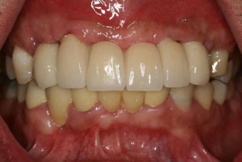 홍태영 김만용 윤준호 Fig. 10. linical pictures and panoramic radiograph after the placement of definitive prosthesis. () Frontal view, () Maxillary occlusal view, () T-screw located on lingual side.