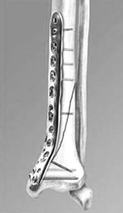 금속판의길이는골절부를충분히수용할수있는길이의것을사용하며, 보통골절부길이의 2 3 