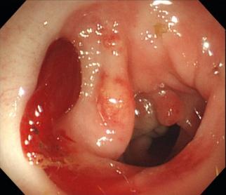 - The Korean Journal of Medicine: Vol. 85, No. 6, 2013 - 확한진단과치료가필수적이다. 본고에서는대장게실의출혈과천공의진단과치료에대해논하고자한다. 본론대장게실출혈전체게실증환자의약 10-25% 에서게실염이발생하는것으로알려져있는반면 [1,2] 게실출혈은 5% 의게실환자에서발생하는것으로보고되었다 [3].