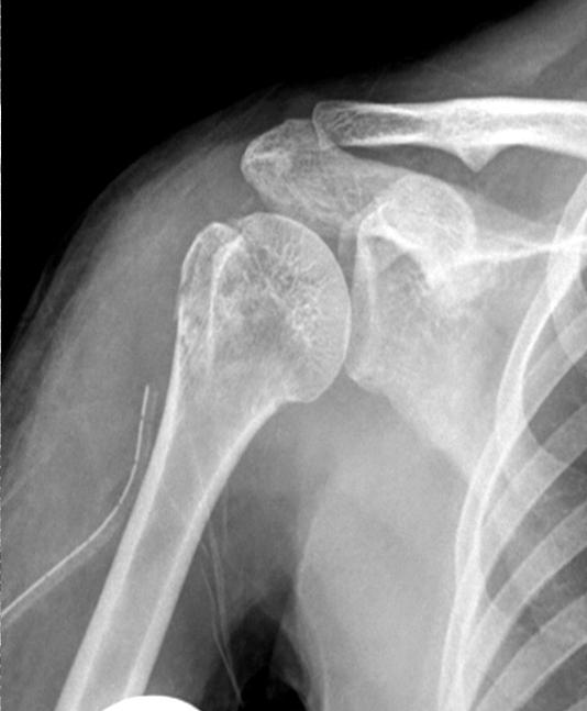 fracture of a 36 years old female patient.