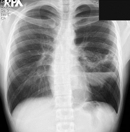 The CT scan at the level of left main bronchus reveals innumerable fine cystic lesions in the superior segment of the left lower lobe