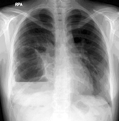 Chest PA shows a cystic lesion with air fluid level and pericystic pneumonic infiltration in right lower lobe on admission (A).