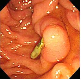 (D) Six-month follow-up endoscopy showed cicatrical change with an attached hemoclip. D 신경절세포부신경절종으로진단하였다.