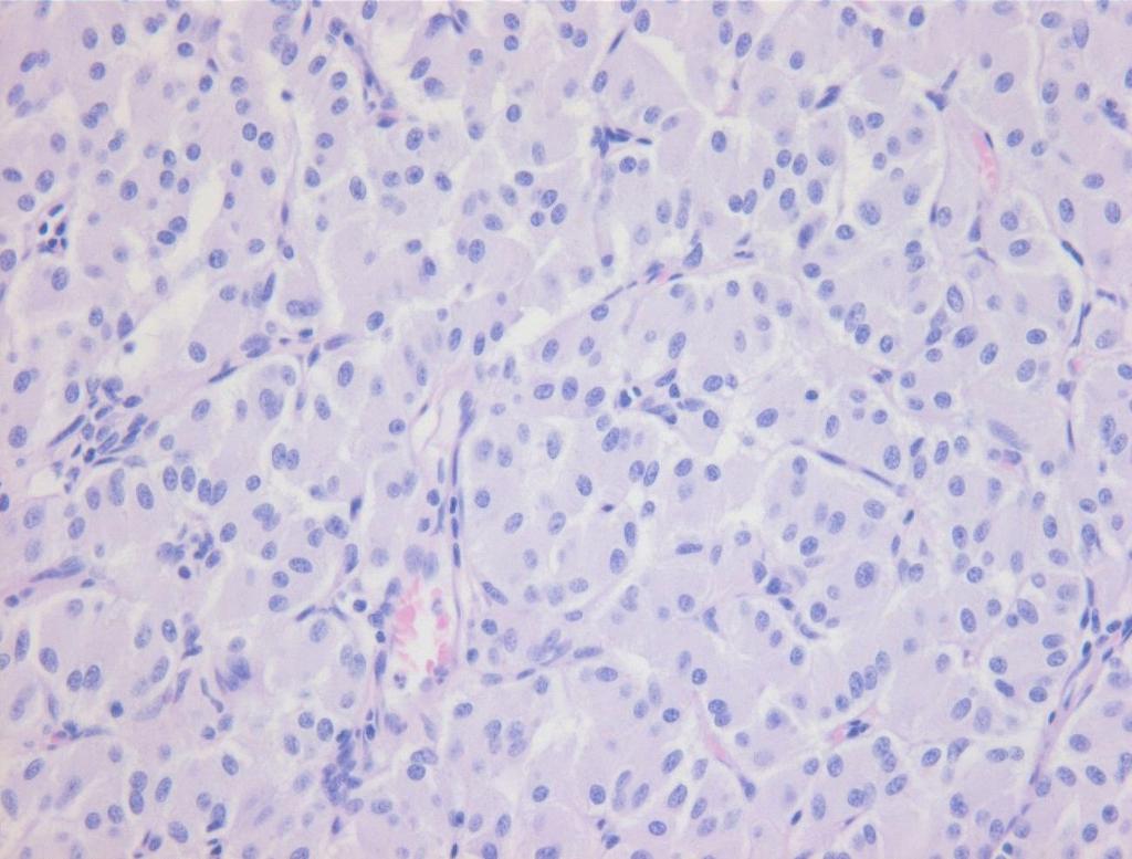 pattern). The tumor cells were positive for synaptophysin in epitheloid cells and ganglion cells (C, synaptophysin, 400).