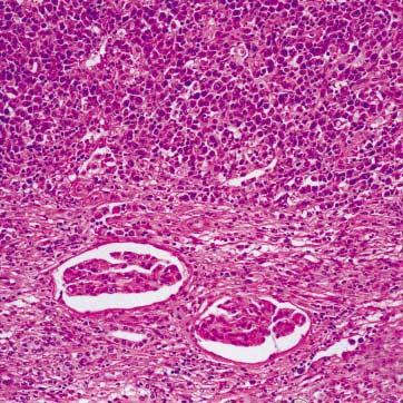 soft tissue and renal parenchyma. (B) The mass infiltrates into the renal parenchyma with pushing margin.